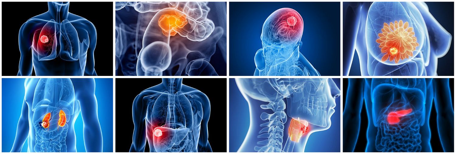 Novel glutamine antagonist prodrugs to be developed as anticancer therapies